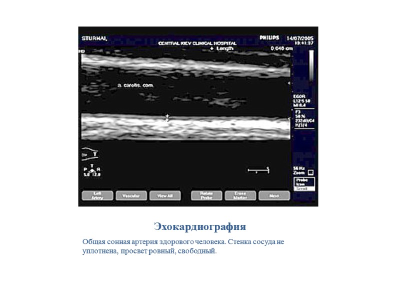 Эхокардиография Общая сонная артерия здорового человека. Стенка сосуда не уплотнена, просвет ровный, свободный.